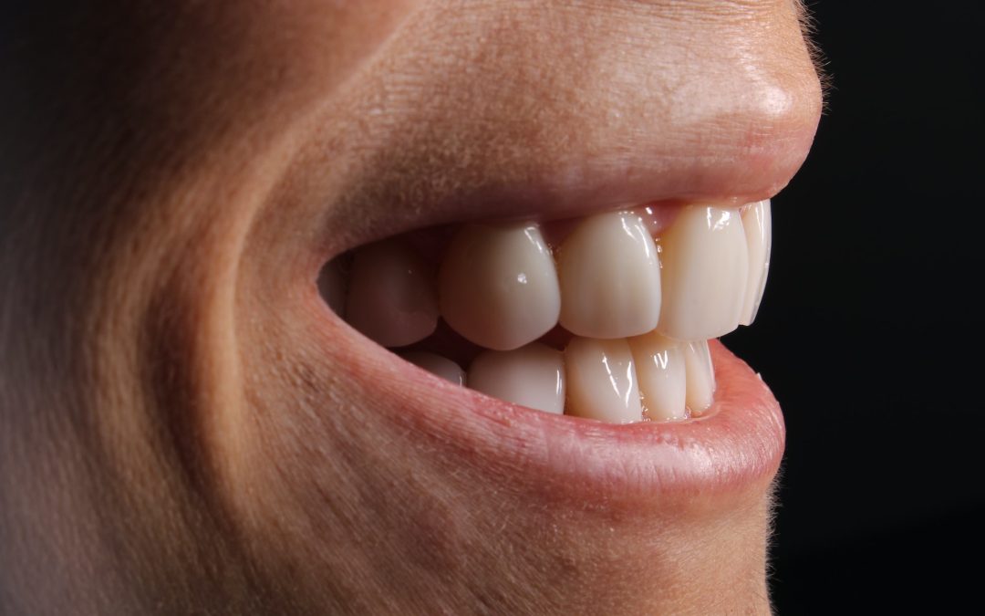 6 Reasons You Should Consider Getting Dental Veneers